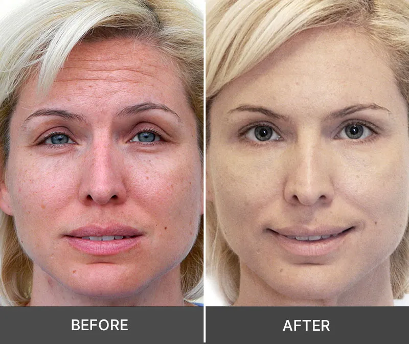 How Does Idrotherapy Cream Works?